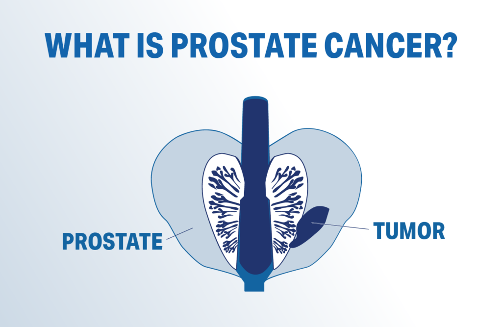 The Prostate & Cancer Diagnosis - Prostate Cancer Centre